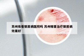 苏州有看银屑病医院吗 苏州哪里治疗银屑病效果好