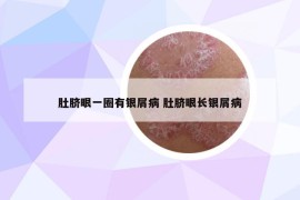 肚脐眼一圈有银屑病 肚脐眼长银屑病