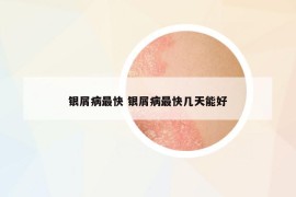 银屑病最快 银屑病最快几天能好