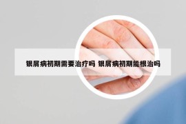 银屑病初期需要治疗吗 银屑病初期能根治吗