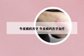 牛皮癣的方子 牛皮癣的方子治疗