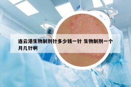 连云港生物制剂针多少钱一针 生物制剂一个月几针啊