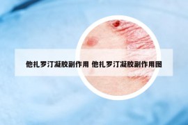 他扎罗汀凝胶副作用 他扎罗汀凝胶副作用图