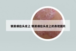 银屑病在头皮上 银屑病在头皮上的表现图片