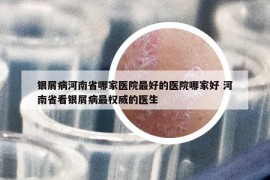 银屑病河南省哪家医院最好的医院哪家好 河南省看银屑病最权威的医生