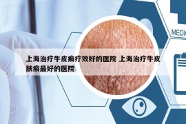 上海治疗牛皮癣疗效好的医院 上海治疗牛皮肤癣最好的医院