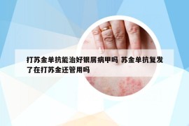 打苏金单抗能治好银屑病甲吗 苏金单抗复发了在打苏金还管用吗