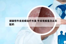 顽固性牛皮皮癣治疗方案 牛皮有癣是怎么引起的