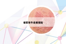 谁家有牛皮癣保险