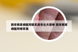 西安银屑病医院联系西安北方很棒 西安银屑病医院哪家强