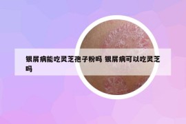 银屑病能吃灵芝孢子粉吗 银屑病可以吃灵芝吗