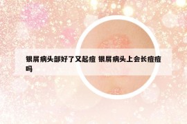 银屑病头部好了又起痘 银屑病头上会长痘痘吗