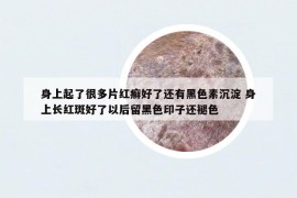 身上起了很多片红癣好了还有黑色素沉淀 身上长红斑好了以后留黑色印子还褪色