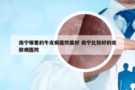 南宁哪里的牛皮癣医院最好 南宁比较好的皮肤病医院
