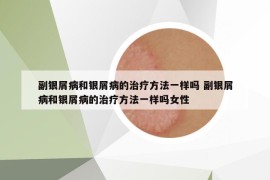 副银屑病和银屑病的治疗方法一样吗 副银屑病和银屑病的治疗方法一样吗女性