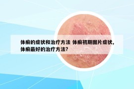 体癣的症状和治疗方法 体癣初期图片症状,体癣最好的治疗方法?