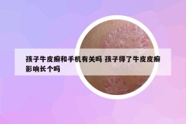 孩子牛皮癣和手机有关吗 孩子得了牛皮皮癣影响长个吗
