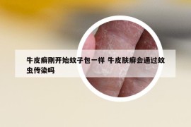 牛皮癣刚开始蚊子包一样 牛皮肤癣会通过蚊虫传染吗