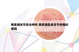 银屑病关节背会疼吗 银屑病患者关节疼痛的原因