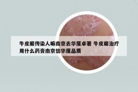 牛皮廨传染人嘛南京去华厦卓著 牛皮廨治疗用什么药膏南京信华厦品质