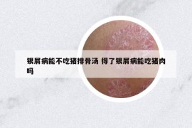 银屑病能不吃猪排骨汤 得了银屑病能吃猪肉吗