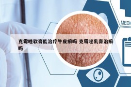 克霉唑软膏能治疗牛皮癣吗 克霉唑乳膏治癣吗