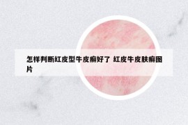 怎样判断红皮型牛皮癣好了 红皮牛皮肤癣图片