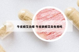 牛皮癣艾灸痒 牛皮肤癣艾灸有用吗