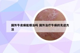国外牛皮癣能根治吗 国外治疗牛癣的先进方法
