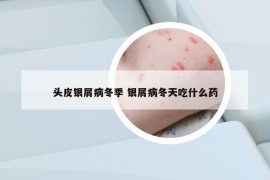 头皮银屑病冬季 银屑病冬天吃什么药