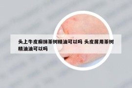 头上牛皮癣抹茶树精油可以吗 头皮屑用茶树精油油可以吗