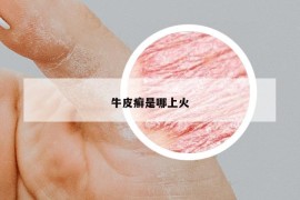 牛皮癣是哪上火