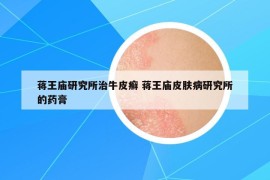 蒋王庙研究所治牛皮癣 蒋王庙皮肤病研究所的药膏