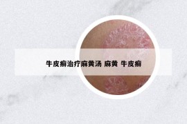 牛皮癣治疗麻黄汤 麻黄 牛皮癣