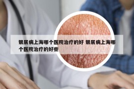银屑病上海哪个医院治疗的好 银屑病上海哪个医院治疗的好些