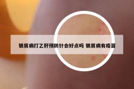 银屑病打乙肝预防针会好点吗 银屑病有疫苗