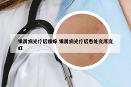 银屑病光疗后瘙痒 银屑病光疗后患处变厚变红