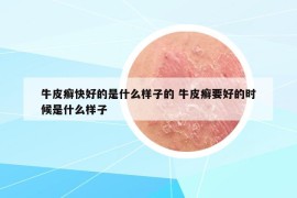 牛皮癣快好的是什么样子的 牛皮癣要好的时候是什么样子