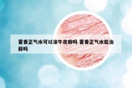 藿香正气水可以涂牛皮癣吗 藿香正气水能治藓吗