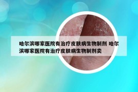 哈尔滨哪家医院有治疗皮肤病生物制剂 哈尔滨哪家医院有治疗皮肤病生物制剂卖