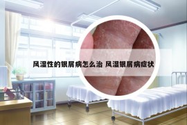 风湿性的银屑病怎么治 风湿银屑病症状