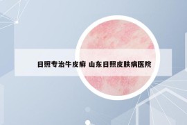 日照专治牛皮癣 山东日照皮肤病医院