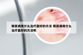 银屑病用什么治疗最好的方法 银屑病用什么治疗最好的方法呢