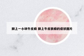 脚上一小块牛皮癣 脚上牛皮肤癣的症状图片