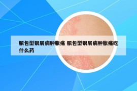 脓包型银屑病肿胀痛 脓包型银屑病肿胀痛吃什么药