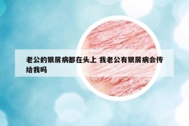 老公的银屑病都在头上 我老公有银屑病会传给我吗