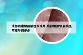 成都银康银屑病医院挂号 成都银康银屑病医院挂号费多少