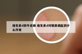 维生素d和牛皮癣 维生素d对银屑病起到什么作用
