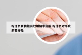 吃什么食物能有效缓解牛皮癣 吃什么对牛皮癣有好处