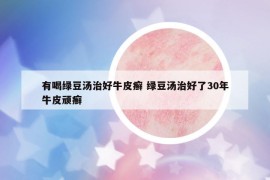 有喝绿豆汤治好牛皮癣 绿豆汤治好了30年牛皮顽癣
